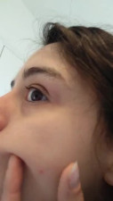 PIMPLE POPPING! Spontaneously Orgasming Crazy Camgirl PinkMoonLust Pops Pimples Face & Talks Orgasm