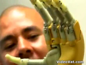 The I Limb Bionic hand