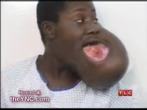 Massive Mouth Tumor