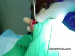 Ingrown toe nail
